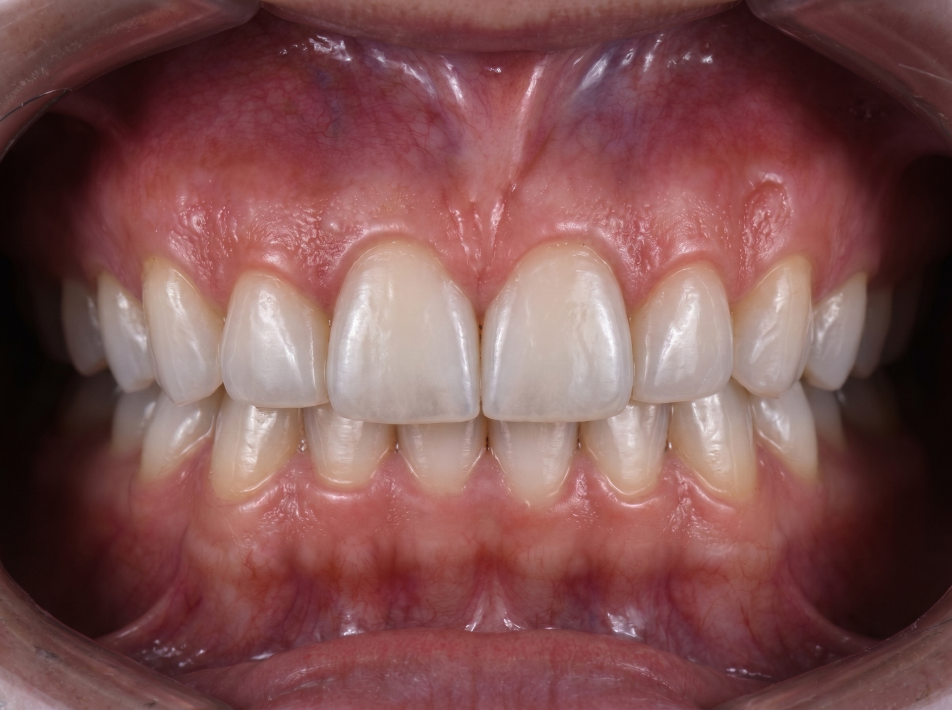 Dentística - Estética