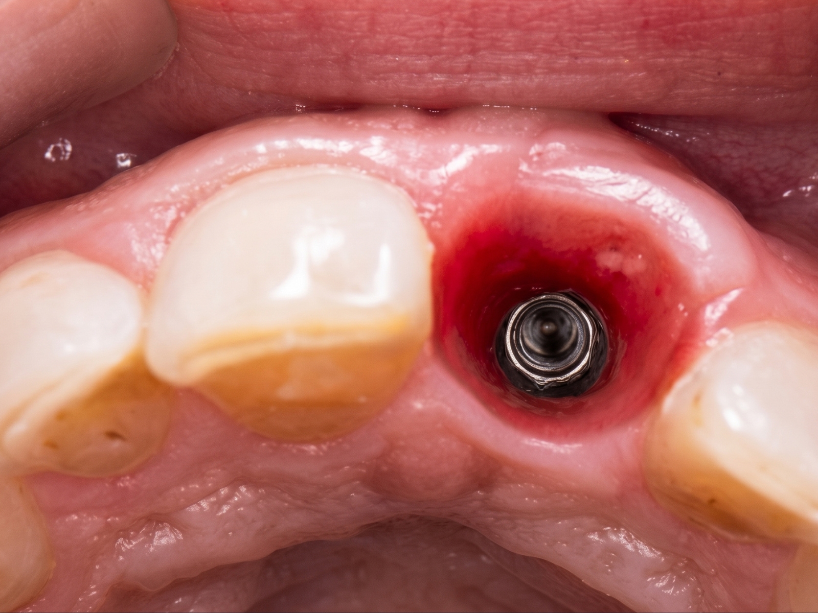 Implantes